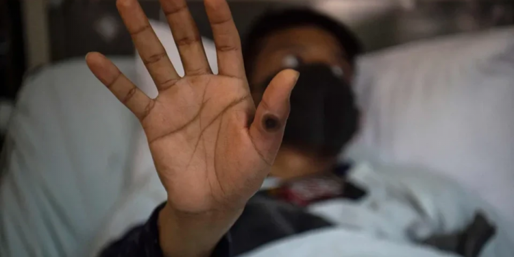 Alerta no Rio de Janeiro: 15 Novos Casos de Mpox Registrados em Menos de Uma Semana