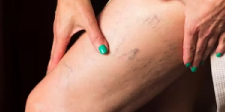 Desvendando os mitos e realidades das varizes