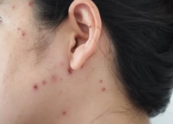 Mulher é internada na Itália com suspeita da misteriosa ‘Doença X’, que já matou mais de 170 no Congo