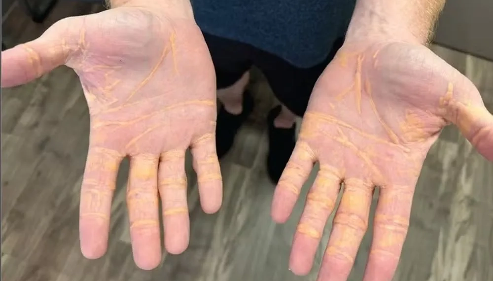 Homem “vaza” colesterol pelas mãos após aderir à dieta carnívora extrema