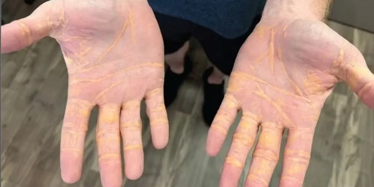 Homem “vaza” colesterol pelas mãos após aderir à dieta carnívora extrema