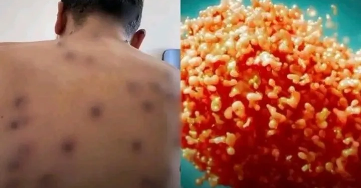 Alerta de Saúde: Primeiro Caso da Cepa Clado Ib da Mpox Confirmado no Brasil