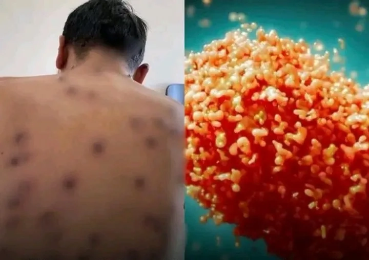 Alerta de Saúde: Primeiro Caso da Cepa Clado Ib da Mpox Confirmado no Brasil