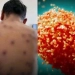 Alerta de Saúde: Primeiro Caso da Cepa Clado Ib da Mpox Confirmado no Brasil