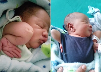 Bebê nasce com doença rara no RJ, mas desafia prognósticos médicos