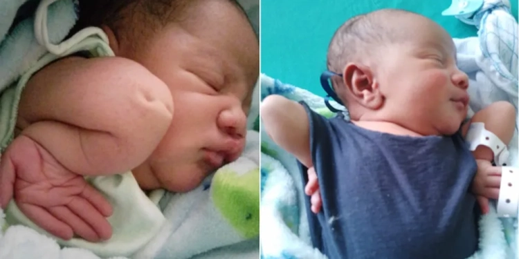 Bebê nasce com doença rara no RJ, mas desafia prognósticos médicos