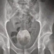 TESÃO INCONTROLÁVEL: Homem de 50 anos dá entrada no hospital com coco inserido no ânus