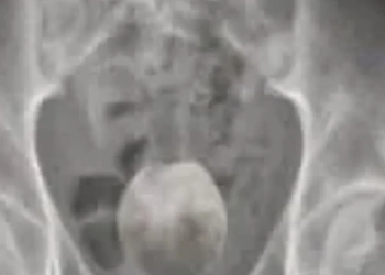 VÍDEO FORTE) HOMEM DE 50 ANOS É INTERNADO COM COCO INSERIDO NO ÂNUS