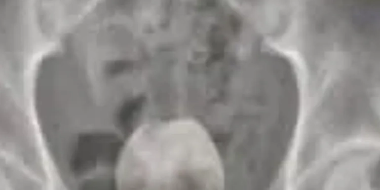 VÍDEO FORTE) HOMEM DE 50 ANOS É INTERNADO COM COCO INSERIDO NO ÂNUS