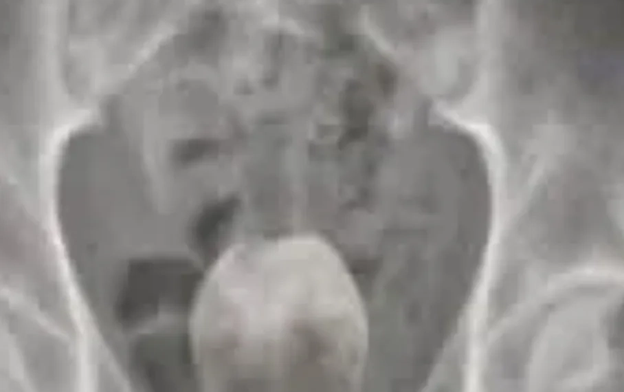 VÍDEO FORTE) HOMEM DE 50 ANOS É INTERNADO COM COCO INSERIDO NO ÂNUS