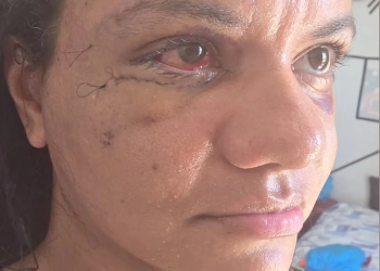 Após 60 socos do namorado, Juliana Soares mostra o rosto reconstruído uma semana após cirurgia