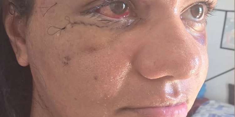 Após 60 socos do namorado, Juliana Soares mostra o rosto reconstruído uma semana após cirurgia