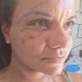 Após 60 socos do namorado, Juliana Soares mostra o rosto reconstruído uma semana após cirurgia