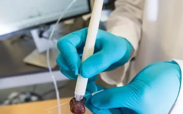 Caneta desenvolvida por brasileira detecta câncer em apenas 90 segundos