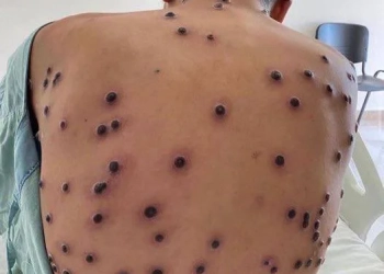 URGENTE: Rio de Janeiro confirma 15 casos de mpox em 2026