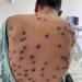 URGENTE: Rio de Janeiro confirma 15 casos de mpox em 2026
