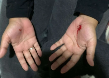 TERROR NA NOITE EM CAMPO GRANDE: ( FOTOS)  MULHER É AGREDIDA SEM MOTIVO APARENTE E FAZ ALERTA À POPULAÇÃO