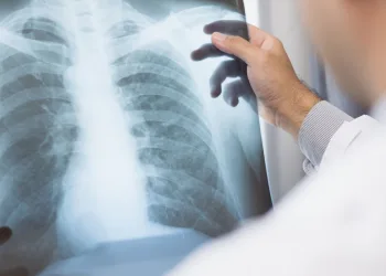 Emrelis para câncer de pulmão avançado, medicamento aprovado pela Anvisa.